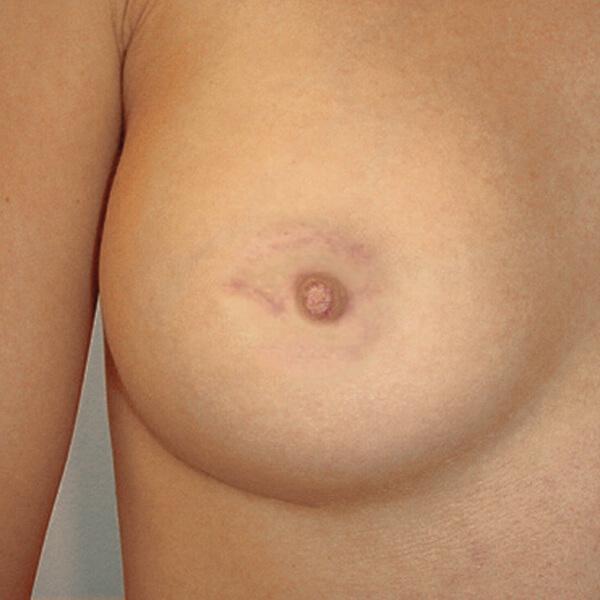 Areola Pigmentierung vorher